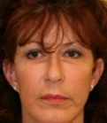 Feel Beautiful - Browlift Case 5 - After Photo